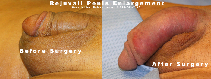 Before After Penis Enlargement Photos 01