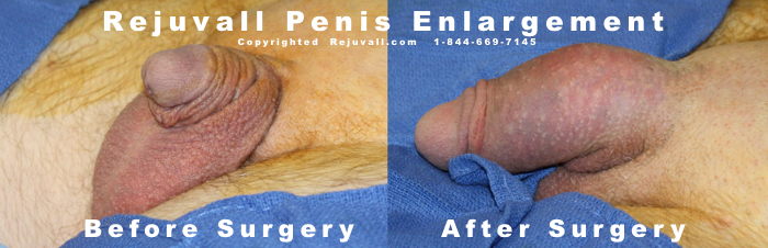 Penile Enlargement Surgery Photos Before After 06