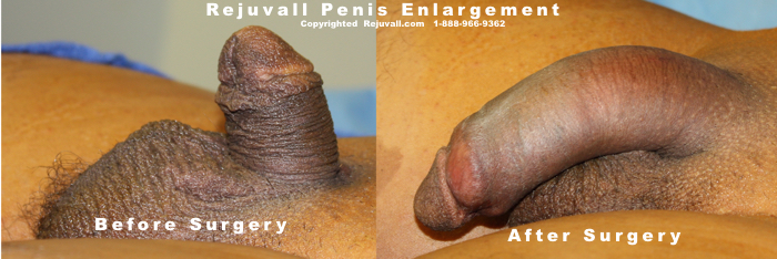 Penis Enlargement Surgery Before After Photo - 02a