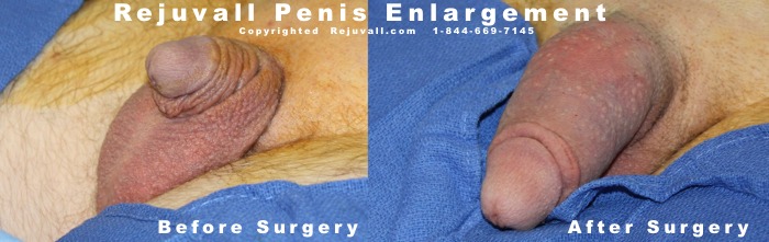 Penis Enlargement Surgery Pictures