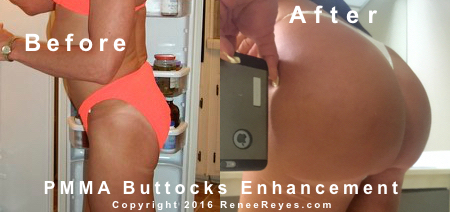 Before After PMMA Buttocks Injections 01
