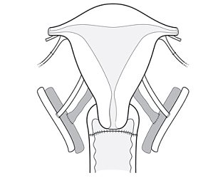 uterus-transplant2