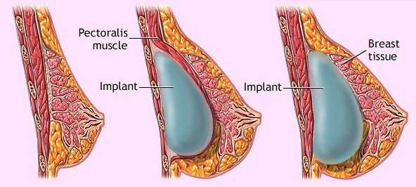 implantlocations